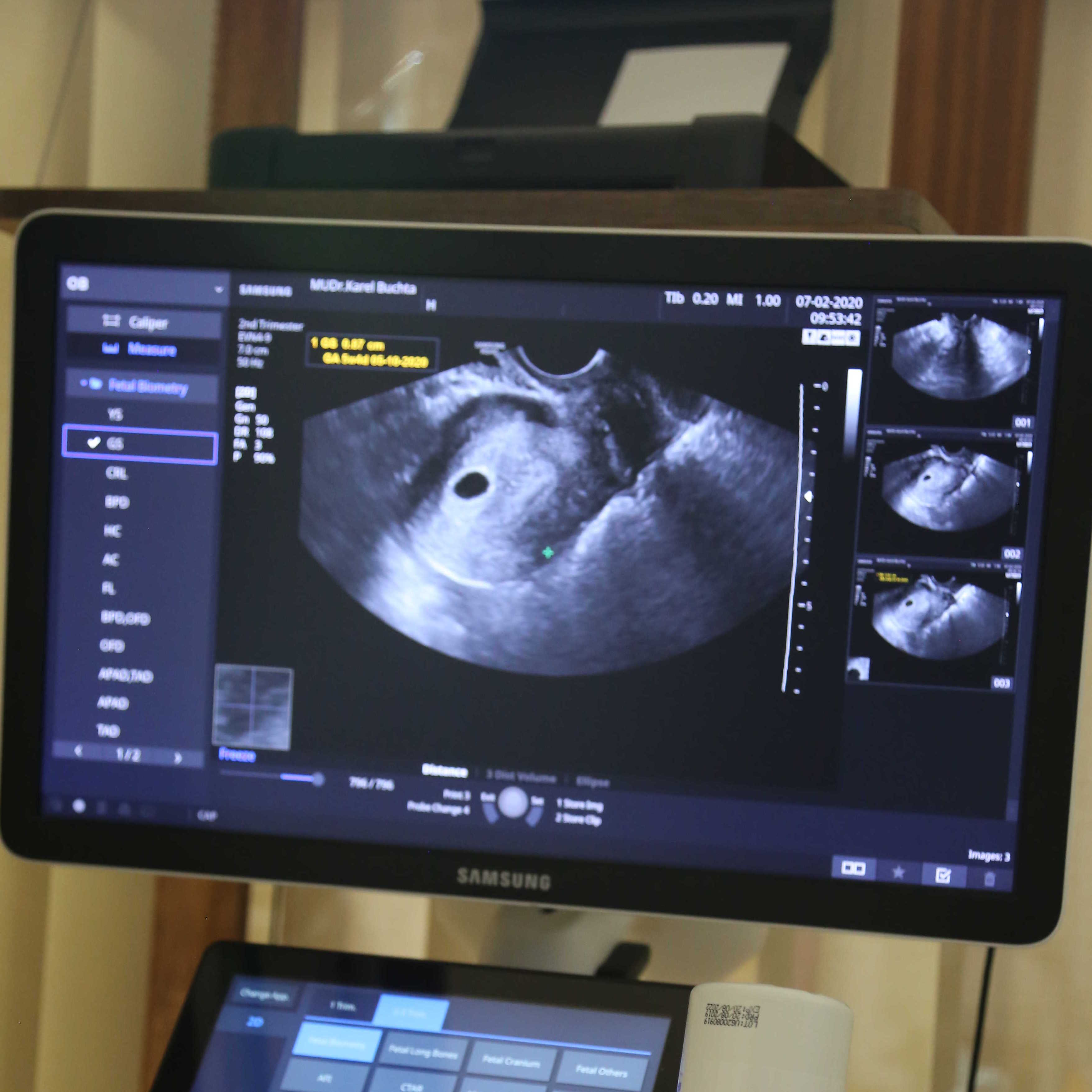 Gynekologické vyšetření